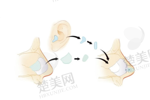 五、患者对王旭明鼻修复的反馈
