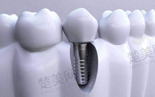 二、泉州美特尔口腔种牙宝龙店诊疗项目