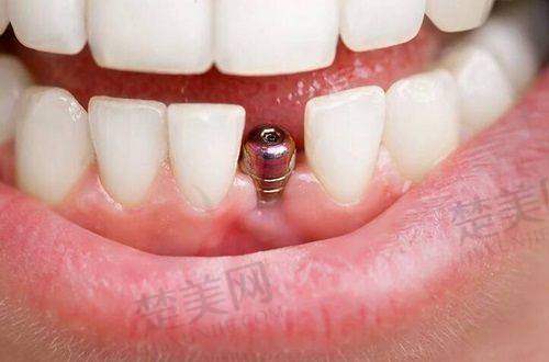 一、郴州种植牙一颗多少钱啊：价格影响因素大揭秘