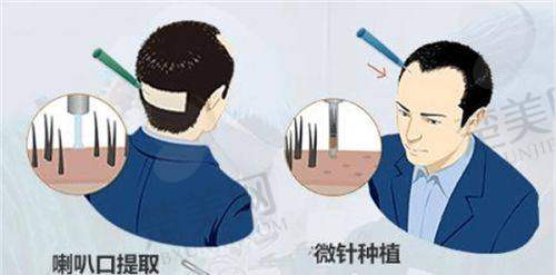 一、北京大学人民医院——综合实力强劲的毛发种植优选