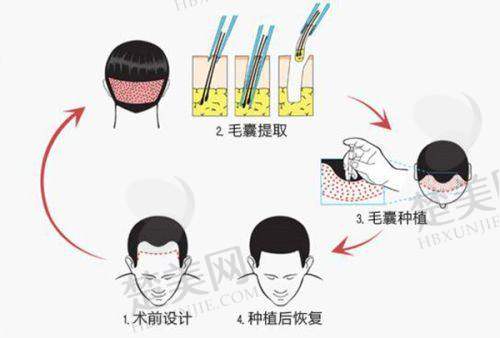 十、选择毛发种植医院的要点