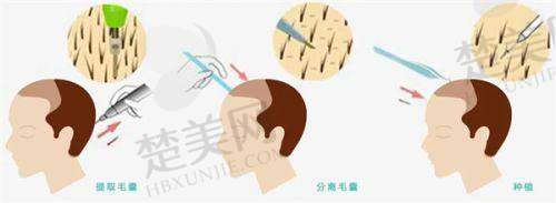 三、中日友好医院——中医和西医结合的毛发诊疗骨干医生