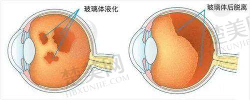 一、乐山爱尔眼科近视手术价格全知道