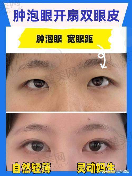 三、广州杨晓英医生眼部修复技术特点