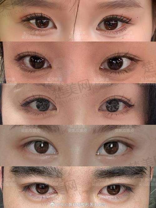 九、郑州眼修复医生排名前十名之张芳医生