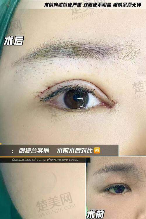 五、苏州维多利亚李寅医生眼部填充价格与服务