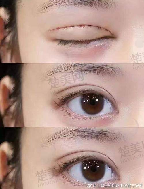 二、苏州维多利亚李寅医生眼部填充技术优势