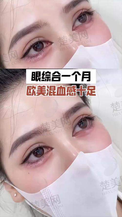 苏州维多利亚李寅医生做眼部填充怎么样?专业技术与审美结合带来自然美观眼部效果!