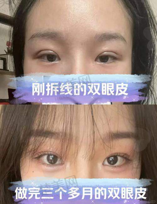 六、总结苏州维多利亚李寅医生眼部填充情况