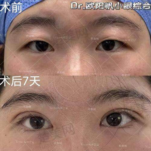 四、苏州维多利亚李寅医生眼部填充实际实例成效