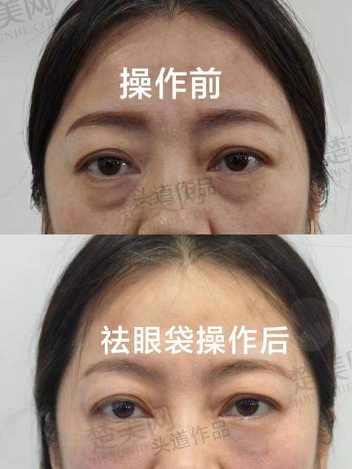 七、广州海峡医疗美容医院郝铁英医生
