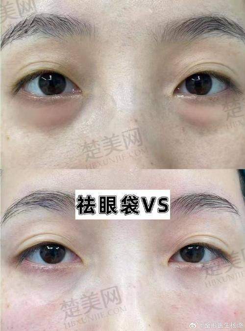 五、广州去眼袋好的医生排名有特色之赵成利医生