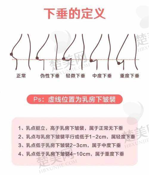三、孙湄杨医生手术实例大揭秘