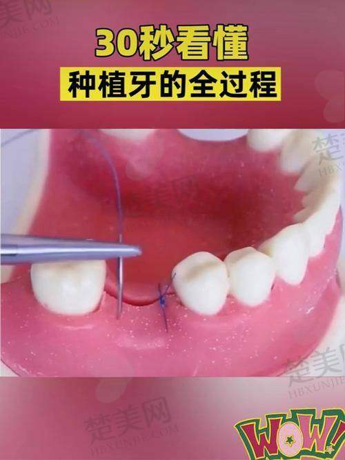 三、襄阳第三人民医院口腔科种植牙的技术亮点