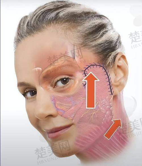 三、毛运春医生拉皮价格影响因素