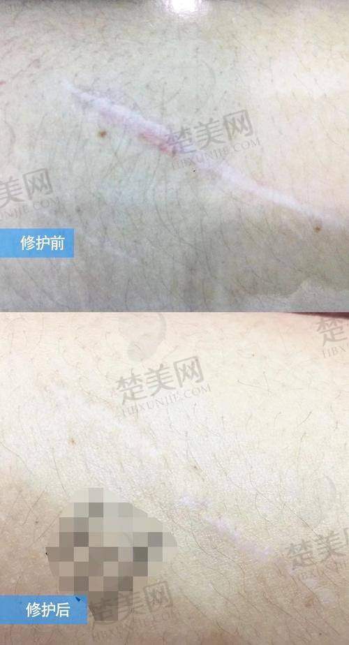 四、苏州市立医院北区——专精烧伤整形的祛疤之选