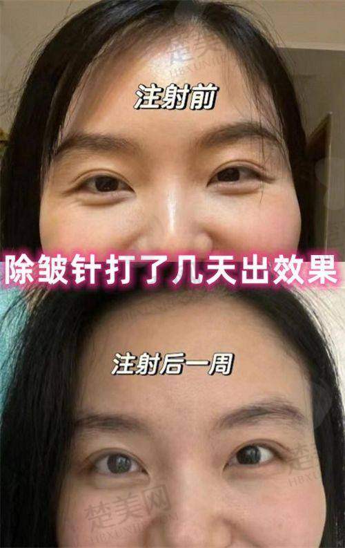 三、不同品牌除皱针的特点及适用部位