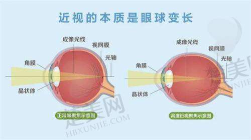 三、爱尔眼科进口角膜塑形镜价格全知道