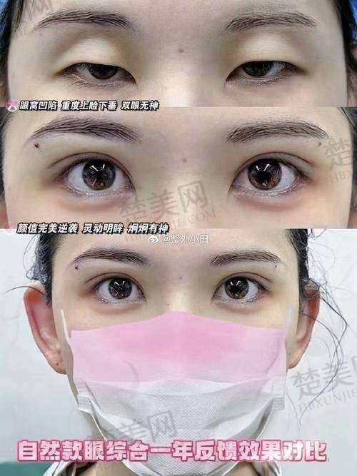六、埋线双眼皮术后注意事项