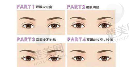 三、孙景波医生修复双眼皮的成功实例