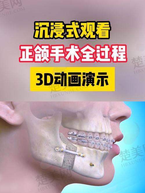 四、艾伟健正颌手术常见实例展示