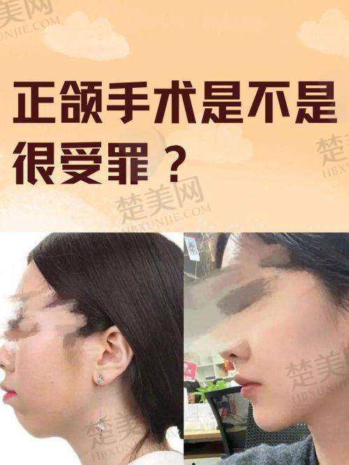 五、艾伟健正颌手术价格大揭秘