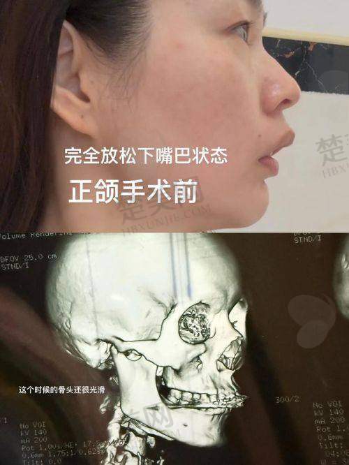 三、艾伟健正颌手术技术优势解读