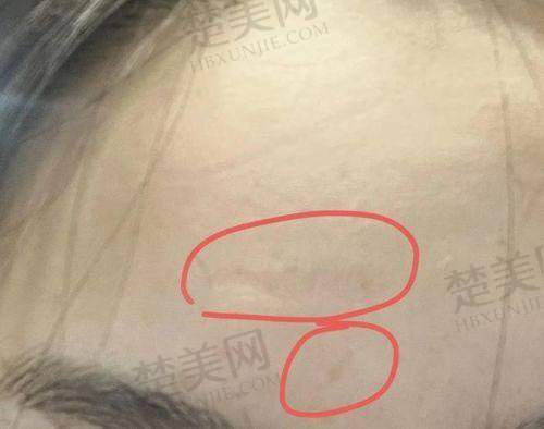 三、深圳鹏程医院疤痕科价格优势及性价比分析