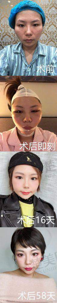 二、上海李志海磨骨技术怎么样