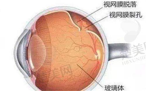 三、爱尔眼科全光塑手术报销的真实实例与常见误区
