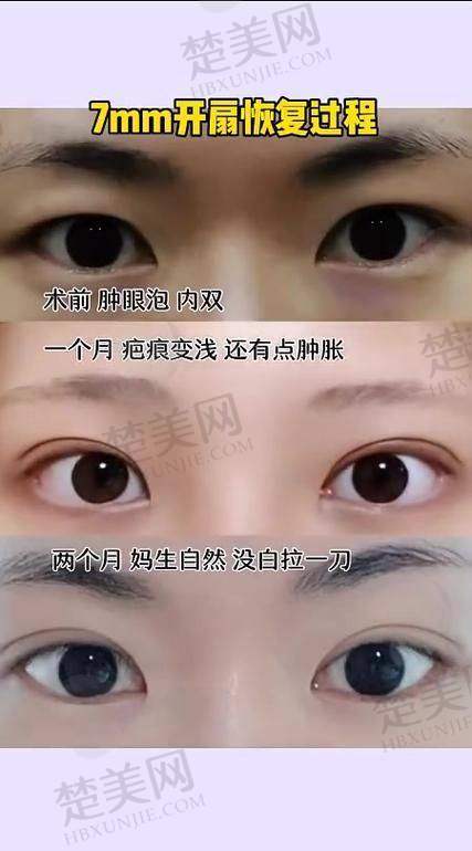 一、伯思立医院双眼皮手术的优势