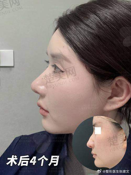 二、厦门私立整形医院假体隆鼻排名情况