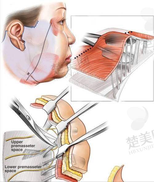 四、广州韩妃风筝小拉皮手术提升下颌缘后3个月成效