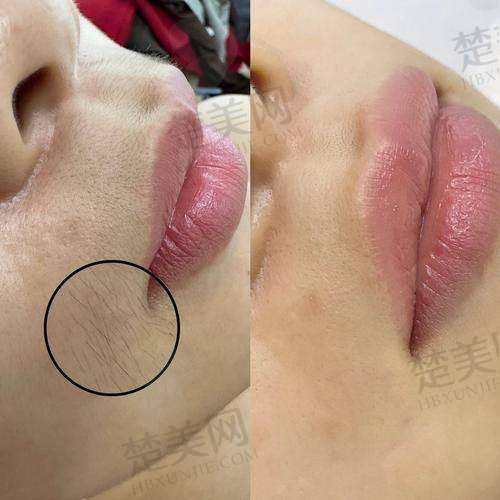 三、兰州皙妍丽整形：专属定制冰点脱毛