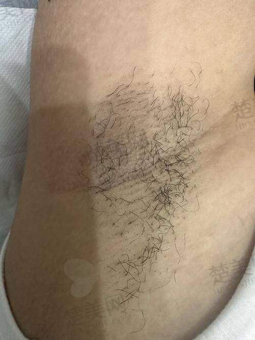 兰州冰点脱毛费用揭秘