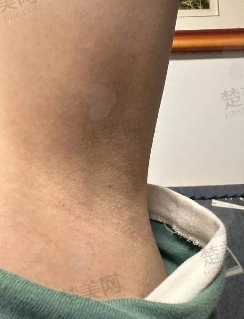 四、兰州梦想整形医院：多模式冰点脱毛更完全