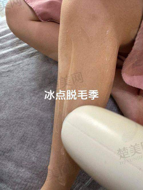 二、华美整形：冰点脱毛优势多