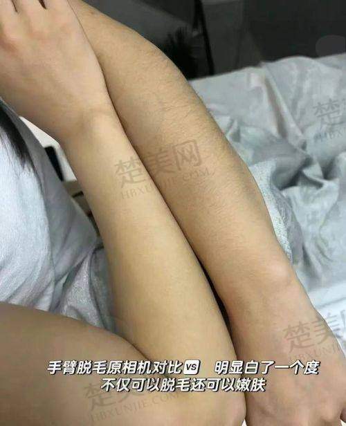 五、兰州崔大夫整形：超冰柔肤脱毛新体验