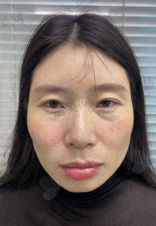 三、刘李娜全脸填充技术原理及过程