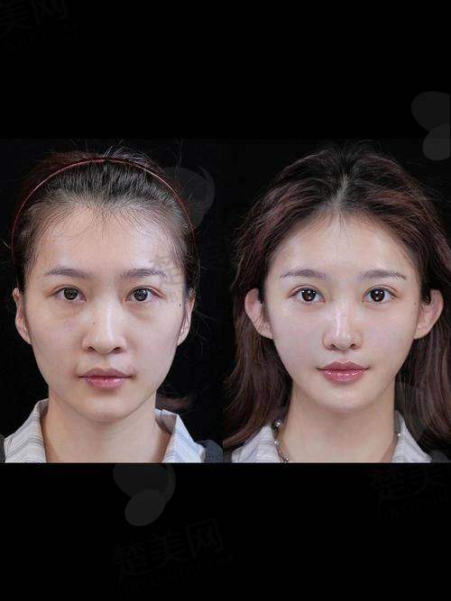 四、刘李娜全脸填充实例分享