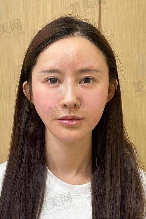 二、刘李娜全脸填充技术优势