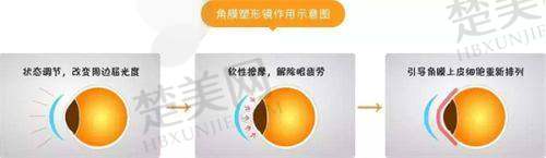 五、周口中视眼科医院全飞秒手术优势总结