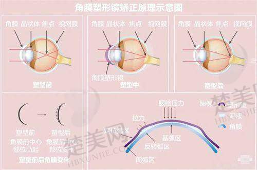 五、河南省人民医院眼科角膜塑形镜（OK 镜）收费
