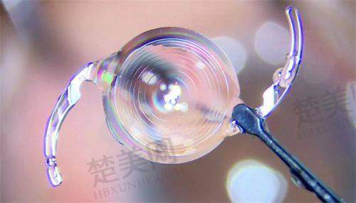 一、刘苏冰医生做近视手术技术咋样？