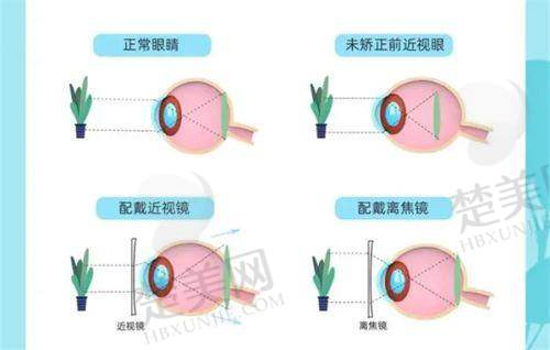 四、不同手术类型的适用人群及修复时间