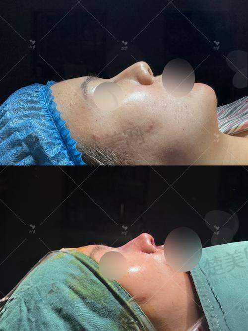 五、张继强隆鼻失败修复价格