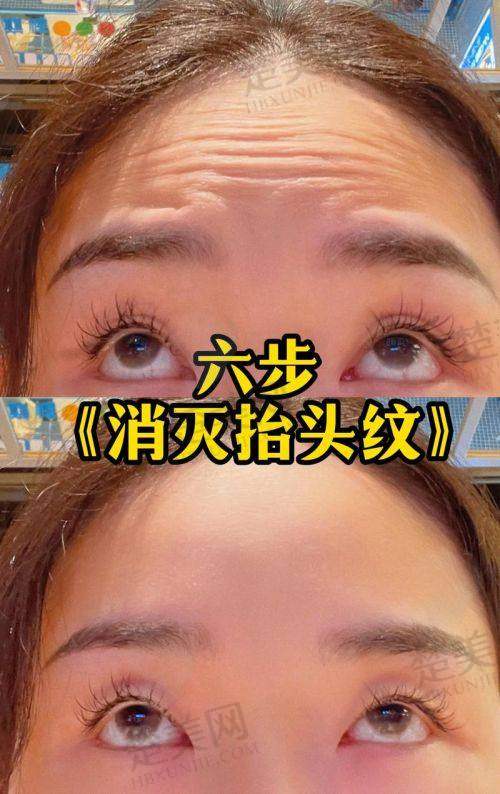 一、探寻抬头纹产生的根源