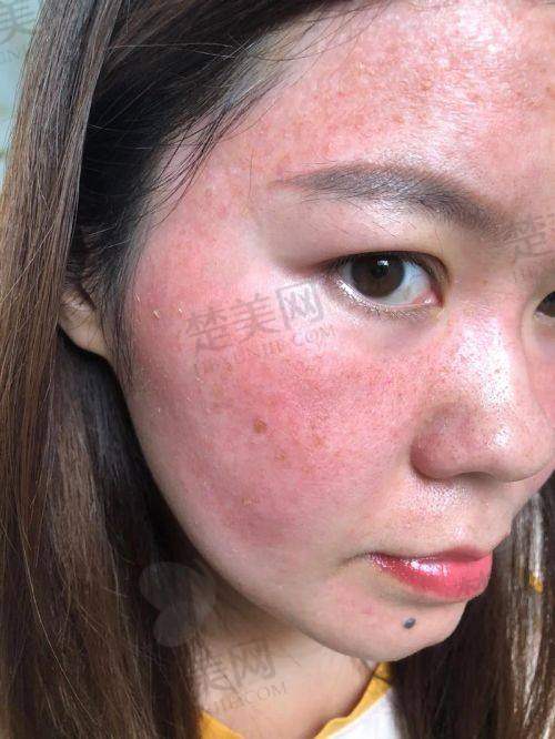 六、不同激光祛斑仪器的特点