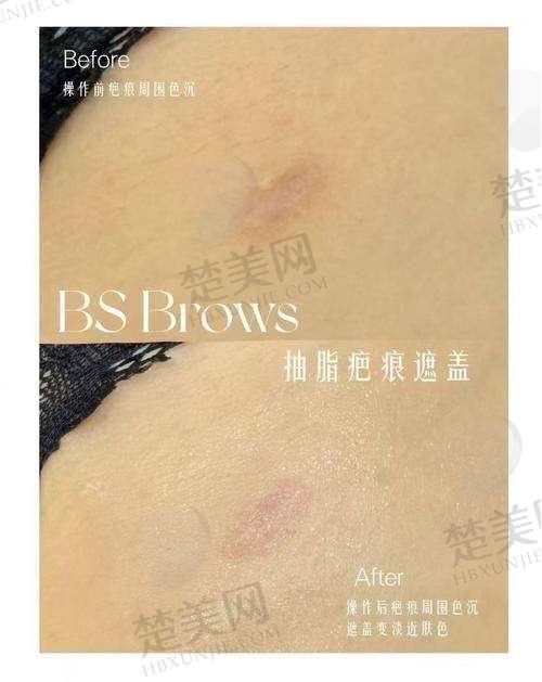 一、兰州大学第一医院——疤痕修复的实力之选