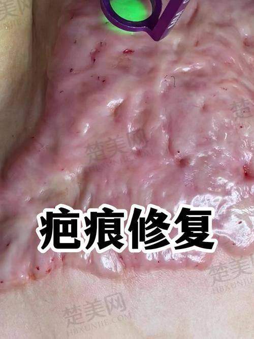四、甘肃省中医院——融合中医特色的疤痕修复医院